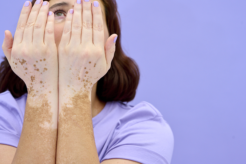 Yaz Aylarında Görünür Olmak: Vitiligo ile Yaşamak ve Kendini Korumak